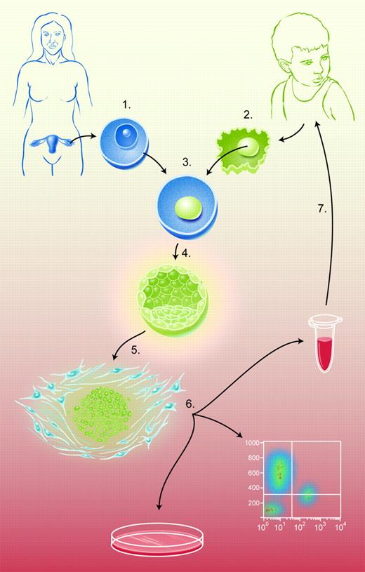 Figure 1. The figure summarizes the nuclear transfer (NT) process as used to create genetically defined hES cell lines. (1) Hyperovulation of female oocyte donors, surgical harvest of oocytes, and oocyte enucleation via micromanipulation to create an ooplast. (2) Research subject somatic-cell donation and enucleation via micromanipulation to isolate donor nucleus. (3) Microinjection of donor nucleus into ooplast to create a reconstituted oocyte. (4) Activation of reconstituted oocyte to induce mitosis. (5) Isolation of inner-cell mass from blastocysts via immunosurgery and establishment cultivation of hES cell line. (6) In vitro analysis/directed differentiation of hES cells. (7) Cellular therapy with in vitro–differentiated, genetically repaired hES-cell derivatives.