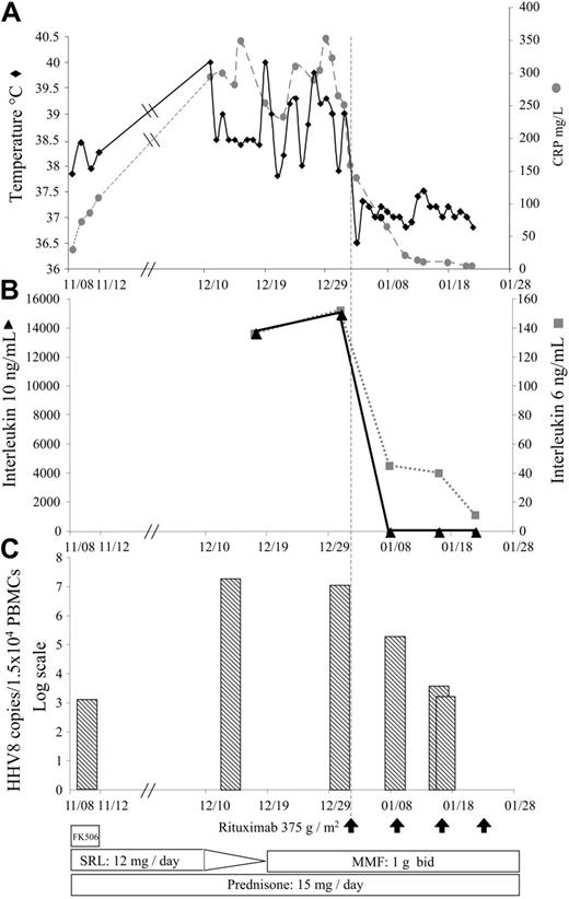 Figure 1. Summary of the patient's clinical history from admission to discharge. (A) Changes in body temperature and serum C reactive protein. (B) Changes in the serum IL-6 and IL-10 levels. (C) Changes in the human herpesvirus-8 viral load evaluated in peripheral blood mononuclear cells by quantitative PCR assay (log scale). Reduction of the immunosuppressive regimen are indicated at the bottom of the figure. Rituximab infusions (375 g/m2) are indicated by arrows. FK506 indicates tacrolimus; SRL, sirolimus; and MMF, mycophenolate mofetil.
