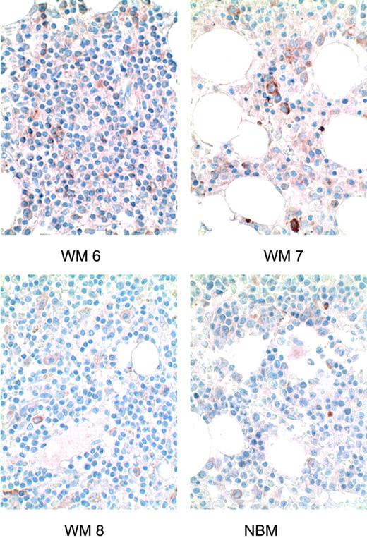 Figure 2. BLyS expression in bone marrow specimens of WM patients. Immunohistochemical analysis of BLyS expression in 3 WM bone marrow specimens (WM 6-WM 8) was performed using anti-BLyS mAb as described in “Materials and methods.” A similar analysis was performed on a normal bone marrow specimen (NBM). Original magnification for images shown: × 600.