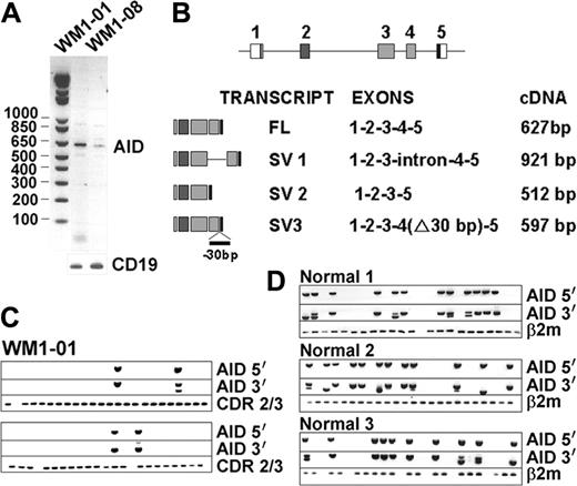 Figure 3. AID is constitutively expressed in some WM samples. Single-stage RT-PCR showed positive bands in 2 WM BM samples (A). Various splice variants (SVs) identified in WM are summarized in panel B. Single-cell analysis of WM1-01 CD20+ cells (C) and activated CD20+ cells of healthy controls (D) were analyzed for clonotypic CDR2/CDR3 and AID expression.