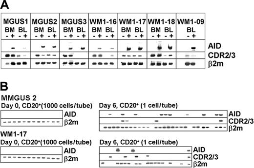 Figure 4. AID is inducible in both WM and IgM MGUS. (A) AID expression is compared before and after CD40L/IL-4 stimulation by bulk RT-PCR. (B) Aliquots of 1000 cells/tube from unstimulated CD20+ B cells were analyzed for AID transcripts (left side of each row) or single CD20+ cells from poststimulated samples were sorted and analyzed for clonotypic and AID transcripts (right side of each row).