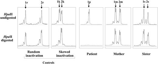 Figure 3. X-chromosome inactivation patterns at the HUMARA locus. Two controls of random inactivation (the presence of both alleles 1r and 2r before and after HpaII digestion) and skewed inactivation (presence of 2 alleles 1k and 2k before and 1 allele 2k after HpaII digestion) are included. The male patient has 1 allele 1p corresponding to his active X chromosome; the same allele is absent after HpaII digestion, indicating its normal active status. Two alleles were detected for the mother (1m and 2m) and the sister (1s and 2s) before and after HpaII digestion, indicating a normal random X-Chr inactivation in both. In most of the diagrams, peaks appear in duplicate, which is the result of unspecific flanking dATP added by the taq polymerase (for some of the product) at the 3′ end of the PCR product. The small peaks to the left side of each major peak are a result of slippage of the taq polymerase during the PCR reaction that results in amplifications of n-1 of the cag repeats.