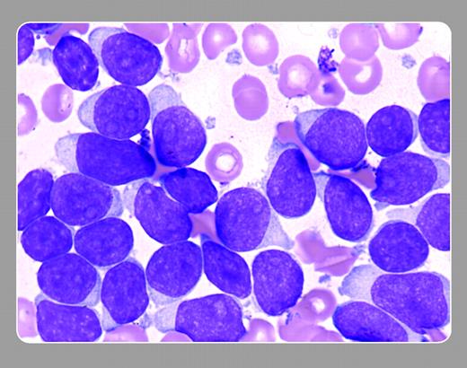 Figure 1. The blasts in the bone marrow aspirate appear “rounded” or “regular” with a scant amount of cytoplasm. Some elongated forms may also be noted. The chromatin pattern is smooth, and few nucleoli may be present. . / Peter Maslak, Memorial Sloan-Kettering Cancer Center
