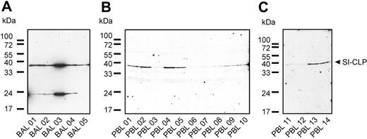 Figure 7. 1C11 monoclonal antibody detects SI-CLP in bronchoalveolar lavage samples and peripheral-blood leukocytes. Western blot analysis was performed using 1C11 mAb. (A) Different pattern of SI-CLP expression was observed in cells isolated out of bronchoalveolar lavage (BAL). BAL 01, 02, 04, and 05 are obtained from patients with chronic bronchitis; BAL 03 was obtained from patient with sarcoidosis, undergoing corticoid therapy. (B-C) PBLs were isolated from fresh blood samples by gradient centrifugation. PBL samples 01 to 05 correspond to BAL samples 01 to 05; PBL samples 06 to 14 are obtained from healthy donors. PBL samples 06 and 11 are obtained from the same healthy donor.