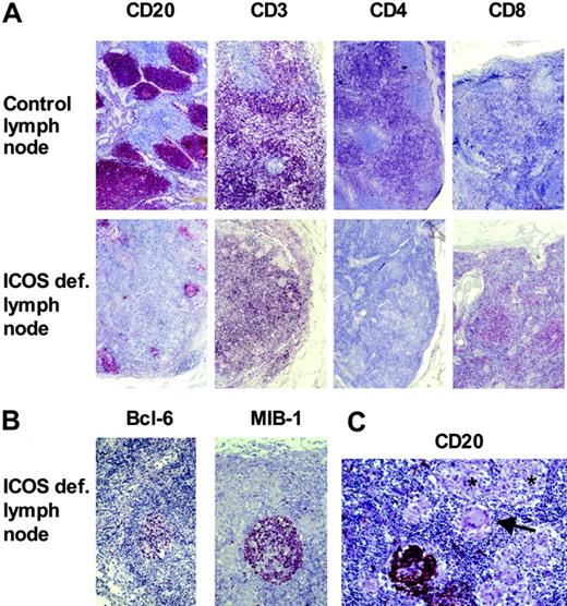 Figure 2. Disturbed secondary structure of lymph nodes in ICOS deficiency. Formalin-embedded inguinal lymph nodes of patient no. 1 and a control patient with carcinoma of the vulva were stained for B cells (CD20), T cells (CD3), and the CD4+ and CD8+ subsets, respectively (A). The ICOS-deficient lymph node contained fewer and smaller B-cell follicles, which were surrounded mainly by CD8+ T cells. The few germinal centers (MIB-1+, bcl-6+) appeared rudimentary (B). In one lymph node of the ICOS-deficient patient, several granulomata (*) with giant cells (arrow) were present, disrupting the follicular structure (C).
