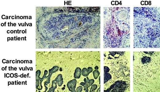 Figure 5. Reduced perilesional lymphocytic infiltration of an invasive carcinoma of the vulva in ICOS deficiency. Paraffin sections of the carcinoma of the vulva of patient 1 demonstrate a reduced infiltration of lymphocytes at the site of invasion. CD4+ T cells were especially diminished compared with an immunocompetent control patient. The number of CD8+ T cells was comparable.