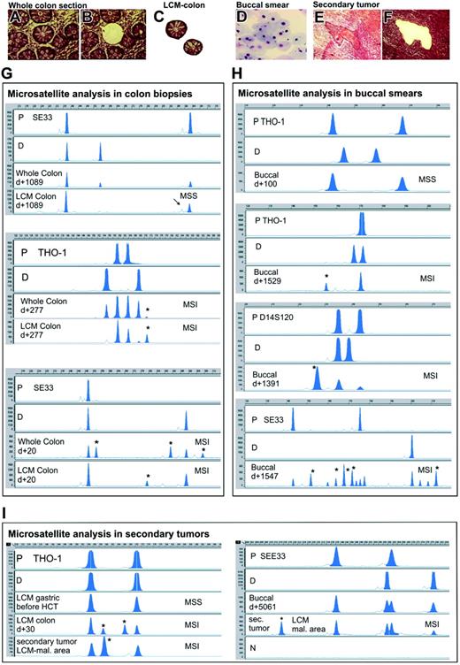 Figure 1. Microsatellite instability in colon epithelium, buccal mucosa, and secondary tumors after allogeneic HCT. Top panels show representative photographs of tissues that were used for microsatellite analysis. An entire colon section before (A) and after (B) laser-capture microdissection of a crypt, 2 laser-microdissected colon crypts (C), a buccal smear (D), and a secondary squamous cell cancer before (E) and after (F) laser microdissection of a malignant area are shown (hematoxylin/eosin stain). Images were visualized using a Zeiss Axiovert 135 microscope and a C-Apochromat 40 ×/1.2 numeric aperture objective (Carl Zeiss, Jena, Germany). Images were acquired using a Zeiss AxioCam MR and Axioplan 2 imaging software. Images were processed using Adobe Photoshop 6.0 (Adobe Systems, San Jose, CA). Panels G, H, and I show representative electropherograms of PCR microsatellite analysis in colon biopsies, buccal smears, and/or secondary tumors. MSS indicates microsatellite stable; MSI, microsatellite instability; P, patient-specific signals as determined from peripheral blood obtained before transplantation; D, donor-specific alleles; Whole Colon, bands found in the examination of a whole colon section; LCM Colon, bands found in examination of 2 laser-captured microdissected colon crypts; Buccal, bands found in the examination of buccal smears; sec. tumor and LCM mal. area, bands found in the examination of a laser-capture microdissected malignant area of a secondary tumor biopsy; N, negative control (no DNA); d+, day of sampling after transplantation; y-axis, relative fluorescent units; and x-axis, fragment length (base pairs). The analyzed microsatellite marker in each case is given. The asterisks indicate novel bands indicative for MSI. The arrow shows a representative stutter peak.