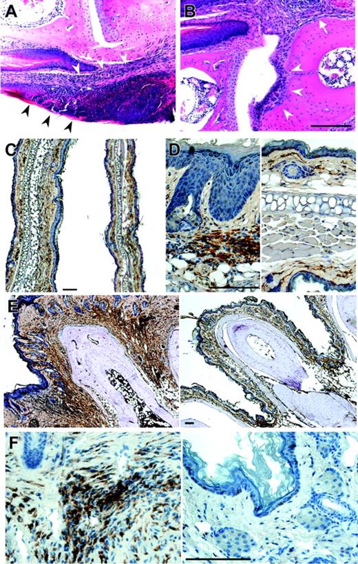 Figure 2. Histology of dermis and paws of homozygous Lupo mice. (A-B) Hematoxylin and eosin staining of an early stage of dermal inflammation. Inflammatory infiltration is restricted to the connective tissue of the corium and the epithelium (arrowheads, A) and paws (B), showing inflammation starting from the corium (arrow) and spreading to erode the articular cartilage (arrowheads). (C-D) Low-power (C) and high-power (D) images of ears of Lupo (left panels) and WT (right panels) mice, immunostained for the macrophage marker, F4/80+, and counterstained with hematoxylin, showing increased ear thickness, hyperkeratosis, acanthotic epidermis, and increased macrophage infiltration in the external ears of the Lupo mice. (E-F) Low-power (E) and high-power (F) images of paws of Lupo (left panels) and WT (right panels) mice, immunostained for the macrophage marker F4/80+ and counterstained with hematoxylin, showing increased paw thickness, acanthotic epidermis, and increased macrophage infiltration in the footpads of the Lupo mice. Bars, 100 μm.