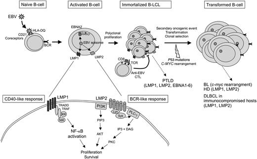 Figure 3. EBV infection and direct transformation of B cells. EBV infects naive B cells through 2 surface receptors, CD21 and the class II MHC, HLA-DQ. During latency, the virus is maintained as an episome in the nucleus of infected cells, and viral genes are expressed, in the absence of lytic replication of the virus. EBV subverts normal B-cell differentiation, notably by the expression of LMP1, a viral latent protein expressed at the surface of infected cells. LMP1 associates with transduction molecules such as TRADD and TRAF and activates the NF-κB pathway in a CD40-like manner. LMP1 is required for the activation and immortalization of B cells. LMP2 is a viral transmembrane protein that associates with Lyn/Syk kinase and PI3 kinase, leading to the activation of PKC and AKT, respectively. LMP2 can substitute for signals emanating from the BCR. Both LMP1 and LMP2 converge to activate proliferation and survival pathways in EBV latently infected cells. EBNA2 transactivates LMP1 and a number of cellular genes involved in activation and proliferation. Polyclonal infected B cells proliferate and produce immortalized lymphoblastoid cell lines in vitro. In vivo, EBV-infected B cells are negatively controlled by anti-EBV cytotoxic T lymphocytes (CTLs). Failure to control EBV-infected B cells may lead to the development of posttransplantation lymphoproliferative disorder (PTLD). Additional oncogenic mutations lead to clonal selection and evolution toward monoclonal tumors such as Burkitt lymphoma (BL), Hodgkin disease (HD), and diffuse large B-cell lymphomas (DLBCLs) in immunocompromised patients.