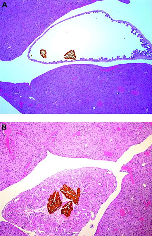 Pigment gallstones in “Berkeley” transgenic sickle cell mice. H&E. (A) Stones in a dilated gallbladder; original magnification, × 12.5. (B) Stones in a hyperplastic gallbladder; original magnification, × 40.