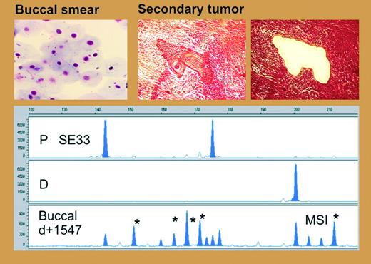 Microsatellite instability in buccal mucosa and secondary tumors after allogeneic HCT. See the complete figure in the article beginning on page 3389.