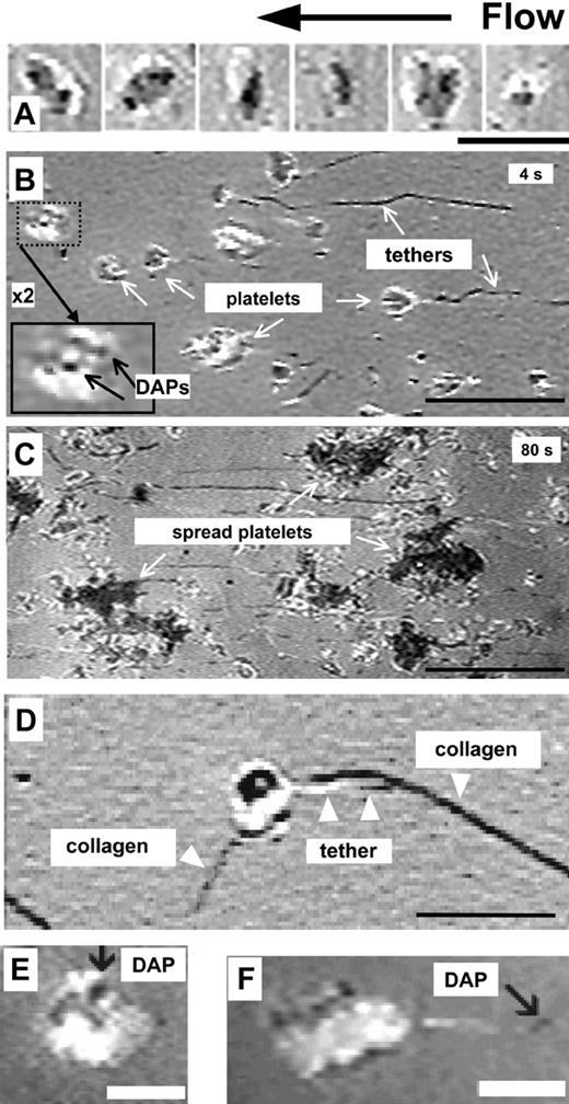 Figure 1. Platelet attachment, tether and PMP formation via DAPs. (A) Washed blood-cell suspension (platelet count, 11 000/μL) perfused over dVWFA1 at γw of 40 000 s–1. Sequential frames of a platelet during translocation are shown from right to left: (1) initial membrane-dVWFA1 surface contact with few prominent DAPs (dark circular areas); (2) increase in the contact area and number of DAPs; (3) turn of bottom side up, with platelet seen on its edge (flip-roll motion); (4-6) sliding and rotation of the platelet body from right to left (translocation without rolling). Scale bar = 5 μm. See also Movies S1 and S5. (B) Whole blood containing PPACK perfused over immobilized VWF multimers at γw of 6 000 s–1. After perfusion for 5 seconds, DAPs within the bodies of surface interacting platelets appear as dark areas (see enlarged inset), and tethers (some with pronounced kinks) extend from the body for variable lengths that may exceed 30 μm. Scale bar = 5 μm. (C) The same surface shown in panel B, but after perfusion for 80 seconds; spread platelets are visible. Scale bar = 10 μm. See Movie S1. (D) Washed blood-cell suspension with 20 μg/mL purified VWF perfused over collagen type I fibrils at γw of 4000 s–1. The platelet count was reduced to 11 000/μL to decrease surface coverage, and 10 μM PGE1 was added to prevent activation. A tethered platelet is seen during initial transient adhesion to collagen-bound VWF. Scale bar = 5 μm. See Movie S4. (E) Washed blood-cell suspension (230 000 platelets/μL) perfused over dVWFA1 at γw of 4000 s–1. Note the attachment to the surface mediated by a DAP within the platelet body. Scale bar = 3 μm. See Movie S5. (F) Washed blood-cell suspension (270 000 platelets/μL) perfused over dVWFA1 at γw of 1000 s–1. Note the attachment to the surface mediated by a DAP at the upstream end of a tether. Scale bar = 3 μm. (See Movie S6).