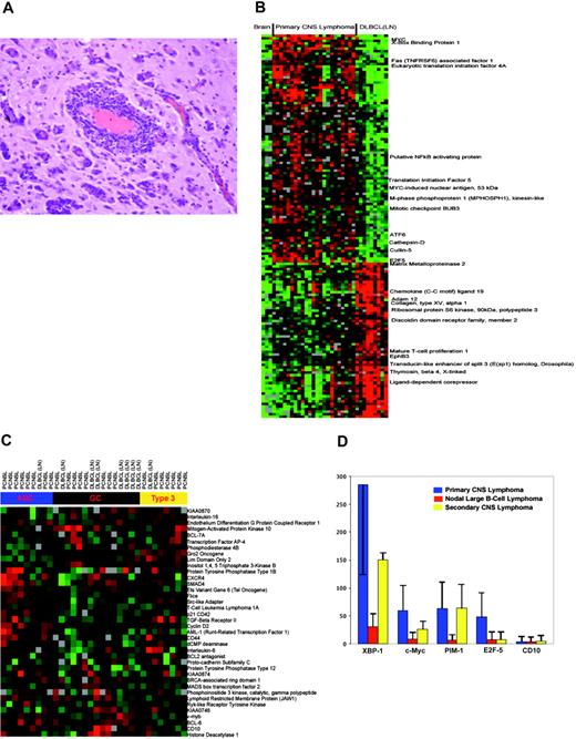 Figure 1. Angiotropism and gene expression in primary CNS lymphoma. (A) Angiotropic growth pattern in primary CNS lymphoma. Hematoxylin and eosin stain were used. Specimens used for gene expression analysis in this study were more highly cellular, consisting of at least 70% tumor cells. (B) Distinctions in gene expression between CNS lymphoma and nodal large B-cell lymphoma. Transcriptional profiles of 23 specimens of primary CNS lymphomas were compared with 3 specimens of nonneoplastic brain and with 9 consecutive specimens of large B-cell lymphoma obtained from lymph nodes. Only genes differentially expressed with a false discovery rate less than 0.01 are shown. The samples are clustered within molecular subtypes and ordered by the subtype. The image reveals distinct patterns of gene expression between CNS lymphomas and nodal lymphomas. Each column represents an individual tumor, and each row represents a single gene. Red indicates up-regulation; green, down-regulation; and black, similar to the median of the reference pool. (C) Assignment of PCNSL and nodal DLBCL tumors to germinal center (GCB), activated B cell (ABC), and type 3 subclasses. PCNSL tumors were distributed equally among the 3 subclasses. Hierarchic clustering was based upon the expression of 38 established marker genes of ABC and GCB subtypes. (D) Mean expression of 4 marker genes distinguishes CNS lymphoma as determined by quantitative real-time PCR in cases of primary CNS lymphomas (blue), large B-cell lymphomas from lymph nodes (red), and secondary CNS lymphomas (metastatic CNS lymphomas; yellow). Y-axis corresponds to percent expression of control gene. Error bars depict standard deviation of mean value. P values refer to the differences in expression between primary CNS lymphomas and nodal large B-cell lymphoma: XBP-1 (P < .001), c-Myc (P < .001), PIM-1 (P < .001), and E2F-5 (P < .001). CD10 expression was similar in the 3 types of lymphomas. Gene expression values obtained by microarray analysis were in agreement with those obtained by quantitative RT-PCR. (The minimum Pearson correlation is 0.65 corresponding to the P value of < .001 for the test of the hypothesis of no association between microarray and Taqman data for these marker genes.)