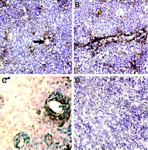Figure 2. XBP-1 expression. Immunohistochemical localization of XBP-1 expression (brown color) in tumor cells surrounding the CNS tumor vasculature in a hematoxylin-stained tumor. (A) Transverse view; arrow points to a blood vessel. (B) Longitudinal view of vessel; XBP-1 immunoreactivity of tumor cells distinguishes them from endothelial cells. (C) Intense XBP-1 immunoreactivity exhibited by a dense population of tumor cells growing around a tumor vessel at the infiltrating edge of a different CNS lymphoma tumor specimen. (D) There was minimal XBP-1 immunoreactivity in a representative specimen of large B-cell lymphoma isolated from a lymph node. When assessed by immunohistochemistry, the pattern of BCL-6 expression was diffuse within CNS lymphomas, not differentially related to the tumor vasculature (not shown). Original magnification × 200 for all panels.