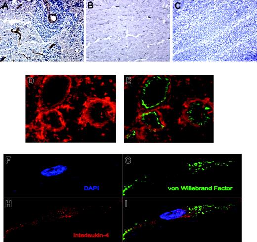 Figure 3. IL-4 expression in primary CNS lymphoma. (A) Immunohistochemical localization of IL-4 (brown color) to vessels associated with angiotropic CNS lymphoma cells at the infiltrating edge of a primary CNS lymphoma. (B) IL-4 immunoreactivity was not detected in the vessels of normal brain. (C) IL-4 immunoreactivity was absent or less prominent in association with the vessels of large B-cell lymphoma isolated from lymph nodes. Original magnification × 200 for panels A-C. (D-E) Dual-color immunofluorescence demonstrates colocalization of IL-4 (D-E; Alexa 594 red immunofluorescence) and von Willebrand factor (E; FITC immunofluorescence) on tumor vessels in primary CNS lymphomas. Original magnification × 400 for panels D-E. (F-I) Endothelial cells in CNS lymphoma are immunoreactive for IL-4 as demonstrated by confocal microscopy. Diffuse cytoplasmic and perinuclear IL-4 expression by an endothelial cell did not exhibit significant spectral overlap with von Willebrand factor expression, which appeared to be localized to specialized Weibel-Palade bodies. Dimensions of displayed images are 68.3 μm × 31.8 μm each.