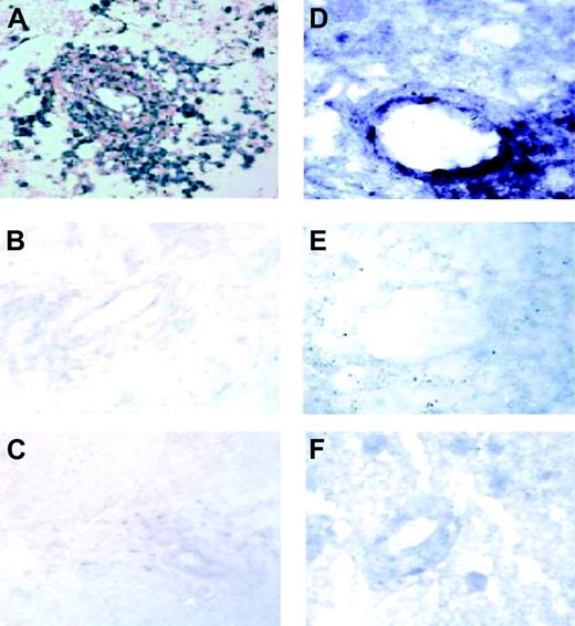 Figure 4. IL-4 in situ hybridization. (A) In situ hybridization with an antisense riboprobe against IL-4 demonstrates gene expression by CNS lymphoma cells. (B) There was no significant hybridization with a sense riboprobe against IL-4 in a parallel section from the same tumor. (C) Tumor cells and vessels in a breast carcinoma metastatic to brain did not exhibit significant hybridization with an antisense riboprobe against IL-4. Original magnification × 200 for panels A-C. (D) In situ hybridization with an antisense riboprobe against IL-4 reveals increased gene expression in a representative CNS lymphoma tumor vessel. (E) There was no significant hybridization with a sense riboprobe against IL-4 in a parallel section from the same tumor. (F) Vessels in normal brain did not exhibit significant hybridization with an antisense riboprobe against IL-4. Original magnification × 400 for panels D-F.