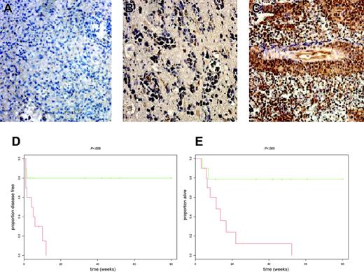 Figure 5. Three common patterns of P-STAT6 expression in PCNSL. (A) Low cellular density; absent P-STAT6 expression. (B) Low cellular density; positive P-STAT6 expression. (C) High cellular density; strong P-STAT6 nuclear expression both by tumor cells and on vascular endothelia. Patients whose tumors exhibited foci of high cellular density with positive P-STAT6 expression (C) had significantly worse outcomes than patients with tumors that were negative for P-STAT6 or tumors that were of low cellular density that scored positive for P-STAT6. Original magnification × 200 for panels A-C. Patients with intense P-STAT6 expression (C; red) experienced early progression (D) and short overall survival (E) when treated initially with high-dose methotrexate-based regimens. Green refers to tumors with sparse or absent P-STAT6 expression. (Whole-brain radiation was reserved for patients with methotrexate-refractory disease.) (Ten patients in each group; P values were calculated by log-rank test.)