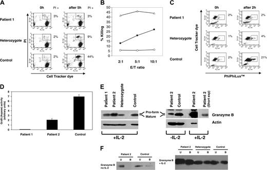 Figure 2. A cytolytic defect in unstimulated NK cells from PLS patients is associated with defective granzyme B processing. (A) Cytolytic activity of unstimulated NK cells derived from PLS patient 1, heterozygote, and healthy control. The killing assay was performed as in Figure 1C except that exogenous IL-2 was not used. The percentage of PI+ target cells is indicated. This experiment is representative of 3 separate killing assays performed and has been confirmed in patient 2. (B) Cytolytic activity of control, heterozygote, and PLS patient NK cells at different effector-target (E/T) ratios. Percentage killing is indicated. ○ indicates patient 1; ▪, heterozygote; ▵, control. (C) Caspase activation by unstimulated NK cells. This experiment was performed as in Figure 1E except that exogenous IL-2 was not used for NK stimulation. Percentages of cells with increased caspase activity are indicated. (D) Granzyme B activity in unstimulated NK cell samples (performed as in Figure 1D); activity is displayed in arbitrary units (standard deviation is shown). A lysate derived from IL-2-activated NK cells contained approximately 4-fold more granzyme B activity than unstimulated NK cells, as in Figure 1D (data not shown). The level of substrate hydrolysis detected in a B-cell line (BJAB), which does not express granzyme B, is similar to the level of activity found in patient 2 (data not shown). (E) Granzyme B immunoblot (using anti-granzyme B antibody clone 2C5/F5) contains lysate from 1 × 106 IL-2-stimulated NK cells per lane or 2 × 106 unstimulated NK cells boiled in SDS-containing loading buffer. A second, shorter exposure of the IL-2-stimulated sample is shown to clearly reveal the different species of granzyme B present in the samples. The unlabeled band at the top of the granzyme B blot highlights the small size difference between granzyme B in the patient and control samples. The mature and pro-form of granzyme B are indicated. Actin was used as a loading control. (F) Aprotinin agarose binding16,17 of granzyme B from unstimulated NK cells and IL-2-activated NK cells from patient 2, heterozygote, and control. Lysates were mixed with aprotinin-agarose beads, the beads were pelleted, and the supernatant removed. The beads were washed and bound (B) and unbound (U) fractions analyzed by granzyme B immunoblotting (as in Figure 2E).