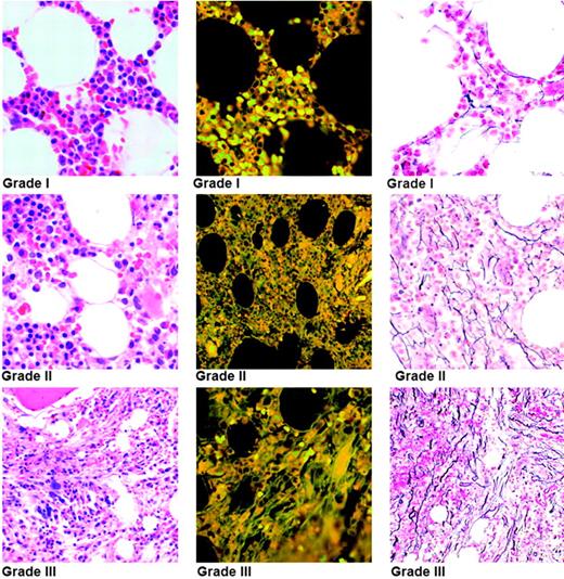 Figure 1. INSERT TITLE. Marrow fibrosis/reticulin content is graded in the reticulin-stained section (right), the corresponding hematoxylin and eosin (H&E)–stained section (left), and autofluorescence of the H&E-stained section (center). The bone marrow images were taken with an Olympus BH2 microscope (Olympus, Tokyo, Japan) with a 20× objective and a final magnification of 100×. The numeric aperture of the Plan Apochromat lens was 0.70. Images were transferred by JPEG high resolution (24-bit color at 1200×) using 800 software Olympus DP-12 and Olympus DP-12 BW acquisition software. Adobe Photoshop CS version 8 (Adobe Systems, San Jose, CA) was used as word processing software.