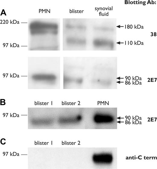 Figure 5. Western immunoblotting of blister and synovial fluid. (A) Western immunoblotting of CD11a and CD18 subunits in 16-hour blister fluid and a synovial effusion from a patient with inflammatory arthritis, using mAbs 38 and 2E7, respectively. Lysates from purified neutrophils (PMN) are shown as a reference standard for full-length CD11a and CD18 chains. (B-C) Comparison of CD18 blotting using mAb 2E7 and anti–C-terminal antibody. Molecular weight size standards are shown on the left. Arrows on the right indicate the position of full-length (180 kDa and 90 kDa) and truncated (110 kDa and 86 kDa) CD11a and CD18 chains, respectively.