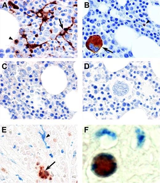 Figure 4. Immune histochemical analysis of normal bone marrow for CD. Serial sections from B5-fixed bone marrow biopsies from healthy donors were subjected to antigen retrieval and incubated with a monoclonal antibody against CD68 (A). The arrow shows macrophages with long cellular processes staining positive for CD68, whereas the arrowhead shows a smaller positively stained mononuclear cell with no cellular processes (similar to the cell shown in panel F). Panel B shows staining with rabbit polyclonal antibody against CXCL7. The arrow points to a positively stained megakaryocyte, also identifiable by large size and multiple nuclei. The arrowhead shows a smaller mononuclear cell positive for CXCL7. The bound antibodies were detected with the HRP-conjugated Envison Plus system (DakoCytomation). Sections stained with appropriate isotype control antibodies are shown in panel C (monoclonal mouse IgG3 antibody) and panel D (polyclonal rabbit antibody). Panels E and F show double immune histochemical staining for CXCL7 and CD68 in bone marrow biopsies from healthy donors. CD68 (blue) is visualized with the Vectastain ABC-AP kit and Vector Blue, and CXCL7 (red) by EnVision Plus/HRP and NovaRED substrate. As shown in panel E, distinct patterns of staining for both CD68 and CXCL7 are observed as in panels A and B, but a small proportion of mononuclear cells without extensive cellular processes also stain for both of the antigens, suggesting that a subset of bone marrow monocytes also express CXCL7. No counterstain was used for panels E and F. All images were acquired using a Nikon Eclipse E800 microscope (Nikon Instruments, Kanagawa, Japan), Coolsnap CF Color Camera (Photometrics, Tucson, AZ), and Metamorph software (Molecular Devices, Sunnyvale, CA). For panels A-D and F, a 100 ×/1.3 NA objective with oil immersion was used; for panel E, a 60 ×/1.4 NA objective with oil immersion was used. Images were adjusted for brightness and contrast with Adobe Photoshop 7.0 (Adobe, San Jose, CA). Panel F was magnified 3 times after acquisition for better cellular detail.