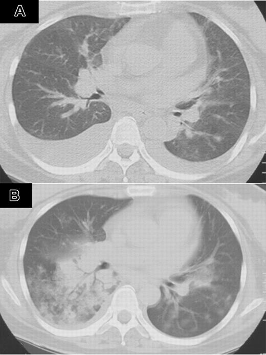 Figure 1. Computed tomography of the chest after treatment with bortezumib (patient 1). (A) CT of the chest 8 days after completion of bortezomib showed bilateral pleural effusion. (B) CT of the chest on day 12 of the second course of bortezomib showed bilateral infiltrates, which rapidly spread to the entire lung field.