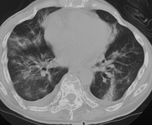 Figure 2. Computed tomography of the chest on the day of the fourth dose of bortezomib showed bilateral pleural effusion and pulmonary infiltrates (patient 3).