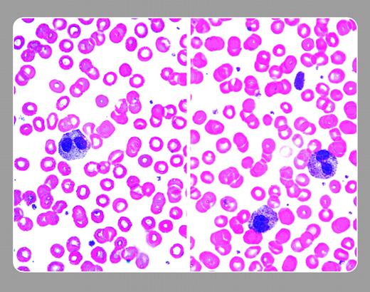 Figure 1. The lefthand blood smear is from a middle-aged male having laboratory testing for an annual physical examination. He had never been ill. The CBC was normal except for a report of increased number of bands. The bilobed polymorphonuclear leukocyte (poly) seen represented approximately 60% of his neutrophils. In 1928 Pelger described the inherited bilobed nuclear abnormality, and Huet reported it a few years later. This benign anomaly is associated with coarse nuclear chromatin and no functional cellular defects. The heterozygote expression of this autosomal dominant disorder (found in 1 of 6000 births) results in bilobed polys; the very rare homozygotic disorder shows monolobed polys. This patient needs no special attention. . / The righthand blood smear is from a patient with mild thrombocytosis. Note a similar bilobed poly as in Pelger-Huet, as well as a giant platelet. This bilobed poly was present in only a few of his white cells. Pseudo Pelger-Huet cells are acquired abnormalities commonly seen in hematology/oncology practice and are markers of underlying disorders, such as myelodys-plasia, myeloproliferative disease including acute leukemia, certain drugs, and occasional acute infections. This patient was diagnosed with essential thrombocythemia. . / Neil Abramson, Baptist Cancer Institute