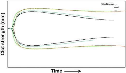 Figure 3. Thromboelastography results for patient 8. Baseline tracing (black) before administration of 50 U/kg rFXIII. Tracings at 28 days (blue) show decreased clot strength (MA) and increased fibrinolysis (increased percentage of Ly60). Tracings from 24 hours (green) and 72 hours (red) show increased clot strength and resistance to fibrinolysis. The x-axis shows time from the addition of sample to thromboelastography, and the y-axis shows distance in millimeters, which reflects clot strength.