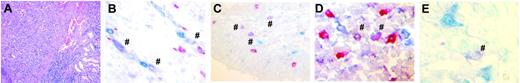 Figure 7. Expression of CD25 and IDO in peritumoral dendritic cells. Example of a gastric carcinoma with considerable inflammatory reaction. Photographs were taken by a JVC digital camera connected to a Zeiss Axiophot microscope. (A) Overview of a sample slide with invasive tumor cell populations and peritumoral inflammatory reaction (magnification, × 100; hematoxylin-eosin staining). (B) Magnification of the border area of the carcinoma: double-immunostaining for S100 (red) and IDO (blue) demonstrates a distinct population of purple-colored double-stained cells (#); magnification, × 1000. (C) Tumor-draining lymph node next to the carcinoma: double immunostaining for S100 (red) and IDO (blue). S100 single-positive DCs (red) as well as S100/IDO-coexpressing cells (purple colored, #) are seen; magnification × 1000. (D) Peritumoral CD25+ cells (red) are more numerous than S100+ DCs (blue). Few double-stained purple cells are visible (#); magnification, × 250. (E) Intratumoral S100+ DCs in close proximity to double-stained S100+ CD25+ DCs (purple colored, #); magnification, × 400. For panel A, a 10 ×/0.32 Plan Apochromat objective lens was used to visualize the image; for panels B-E, a 63 ×/1.40 oil-immersion Plan Apochromat objective lens was used to visualize images.