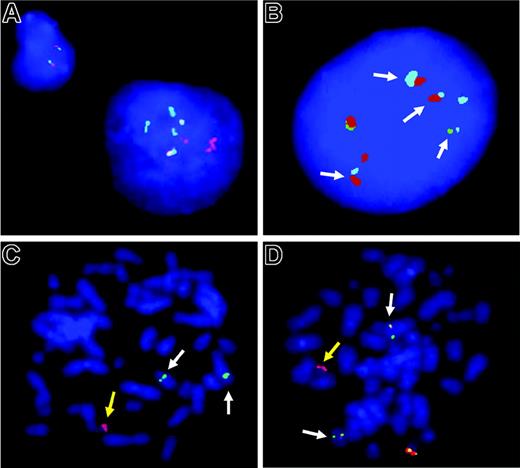 Figure 1. FISH analysis. (A-B) Interphase FISH analyses in cHL with a IGH-BCL3 fusion. (A) The large Hodgkin cell nucleus on the right shows multiple splits of BCL3 break-apart probe, whereas the small cell on the left shows the normal signal pattern for 2 intact BCL3 loci (ie, 2 colocalized signals). (B) Multiple colocalizations of IGH-telomeric (green) and IGH-centromeric (red) probes with a BCL3 spanning probe (pale blue; arrows) confirming IGH-BCL3 juxtaposition in an HRS nucleus of the same case. (C-D) Metaphase FISH analyses in PTCL. (C) Split of the TCRAD break-apart probe indicating a TCRAD breakpoint and concomitant loss of the normal TCRAD allele. The yellow arrow points to the chromosome containing a TCRAD centromeric signal (red), whereas white arrows point to marker chromosomes containing TCRAD telomeric signals (green). (D) Extra red signal for the BCL3 telomeric probe (yellow arrow) and residual red signals colocalizing with the green BCL3 centromeric signal (white arrows), indicating a chromosomal breakpoint slightly telomeric to the BCL3 gene. The yellow and white arrows in panels C and D correspond to the same marker chromosomes, respectively. Images were acquired using a 63 ×/1.40 numeric aperture oil objective in a Zeiss Axioskop2 fluorescence microscope (Zeiss, Göttingen, Germany) equipped with the appropriate filter sets (AHF, Tübingen, Germany) and documented using the ISIS imaging system (MetaSystems, Altlussheim, Germany).