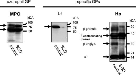 Figure 7. Hp and lactoferrin are absent in blood cells from a patient with SGD. Blood samples from a patient with SGD and a healthy donor (control) were depleted of erythrocytes, and lysates including total nuclear cells (neutrophils and mononuclear cells) and residual plasma were subjected to Western blot analyses using rabbit anti-human MPO, Lf, and Hp antibodies. Western blot analyses demonstrated that blood cells from the SGD patient expressed the azurophil granule protein MPO at comparable levels but expressed neither the specific granule protein Lf nor the highly-glycosylated Hp β-chain with a molecular weight of 45 to 65 kDa. Contamination of cell lysates with residual plasma resulted in the detection of Hp β-chain with a low molecular weight (39 kDa) in the control sample and the sample obtained from the SGD patient.