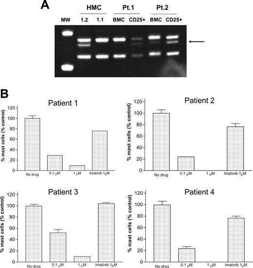 Figure 3. Analysis of primary bone marrow cells obtained from patients with mastocytosis. (A) HinfI restriction analysis of bone marrow cells isolated from patients with systemic mastocytosis. RNA was isolated from either unselected bone marrow or CD25-sorted marrow cells. The presence of the KITD816V mutation is indicated by the appearance of a novel restriction fragment as indicated by the arrow. (B) Primary neoplastic mast-cell viability following culture of bone marrow isolated from 4 patients with systemic mastocytosis in the presence of imatinib or dasatinib. Bars indicate mean ± SEM from duplicate cultures for each dose in 4 different patients. P < .001 comparing no treatment with 0.1 and 1 μM dasatinib by 2-tailed t test on pooled data.