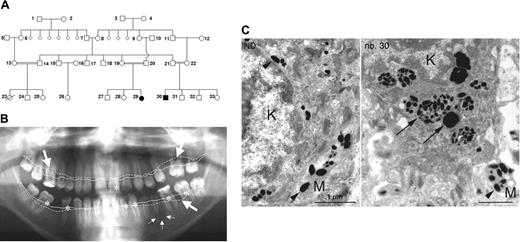 Figure 1. Pedigree and clinical manifestation. (A) Pedigree showing 2 affected individuals (no. 29 and no. 30). (B) Panoramic radiograph revealing aggressive periodontitis as clinical manifestation of congenital neutropenia in patient no. 30. Coronal carious decay is marked by asterisks; periradicular radiolucency around the apex of the second lower left premolar is indicated by small arrows. Bold arrows indicate generalized horizontal alveolar bone loss with vertical drop. Note the difference between expected alveolar bone level (continuous line) and actual alveolar bone margin (dotted line). (C) Transmission electron microscopy of the basal keratinocyte (K) and a melanocyte process (M) from a healthy individual (left) and from patient no. 30 (right). In a healthy individual, mature melanosomes (arrowheads) are translocated from melanocytes to keratinocytes. In AP-3 deficiency, keratinocytes contain large phagosomes of densely packed immature melanosomes (arrows).