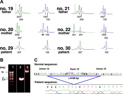 Figure 3. Molecular identification of AP3B1 mutation. (A) Genotypes of the marker D5S424 (76.2 Mb) and D5S1501 (78.5 Mb) of the affected homozygous individuals (no. 29 and no. 30) and the heterozygous parents of the affected individuals (nos. 19-22). (B) Genomic Long-Range PCR of the affected individual no. 30 (lane 2) and the homozygous healthy cousin as a control (lane 3). The PCR product of lane 2 displays a length of only approximately 3000 bp (base pair) in contrast to the expected length of 11 018 bp (lane 3), suggesting a genomic deletion of approximately 8000 bp. Lane 1, size marker. (C) Sequence analysis of the Long-Range (LR) PCR product of the affected individual no. 30, revealing a deletion of 8168 bp.