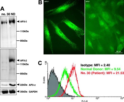 Figure 4. Deficient assembly and function of AP-3 complex. (A) Western blot analysis of fibroblast protein extracts showing decreased concentrations of AP-3 β, δ, and σ subunits. (B) Immunofluorescence analysis demonstrating deficiency of the δ subunit of the AP-3 complex in fibroblasts from patient no. 30 (right) compared with fibroblasts from a healthy control (left). (C) FACS analysis of fibroblasts stained for cell-surface expression of CD63 (LAMP3) revealed increased expression of CD63 on fibroblasts from patient no. 30 (red line) compared with control (green line). The mean fluorescence intensity (MFI) is indicated for the isotype control (gray), healthy donor, and patient no. 30.