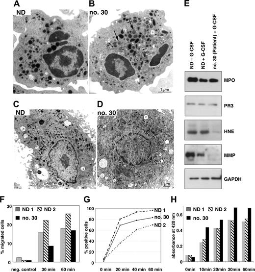 Figure 5. Ultrastructural and functional analysis of neutrophil granulocytes. (A-B) Transmission electron microscopy (TEM) of representative native neutrophil granulocytes from a healthy individual (ND; A) and patient no. 30 (B). The neutrophils of the patient (B) contained higher amounts of granules, demonstrating high degrees of variability in size, shape, and electron density. Immature granules are indicated by arrows. (C-D) TEM of in vitro-differentiated neutrophil granulocytes on exposure to Pseudomonas bacteria. No difference is seen in phagolysosome formation and bacterial degradation in granulocytes from the healthy individual (C) compared with patient (no. 30; D). (E) Western blot analysis of peripheral blood neutrophils obtained from 2 healthy control individuals with and without prior G-CSF treatment and patient no. 30. Complete blots are shown in Figure S1. (F) Chemotaxis assay of peripheral blood neutrophils from 2 healthy control donors (ND 1 and ND 2) and patient no. 30. Cells either migrated toward medium without chemoattractant (negative control) or toward medium supplemented with 10-7 M fMLP. (G) Uptake of FITC-labeled K12 E coli by in vitro-differentiated neutrophils from 2 healthy control donors and patient no. 30. (H) Killing of lactose permease-deficient E coli in peripheral blood neutrophils from 2 control donors (ND 1 and ND 2) and patient no. 30.