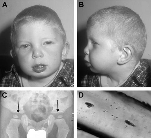 Figure 1. Dysplastic features of the patient. (A-B) Portrait of the patient showing mild dysplastic features. (C) X-ray of the pelvis with flat, dysplastic acetabulae (arrows). (D) Light microscopy of a representative hair of the head, showing unevenly distributed small clumps of pigment.