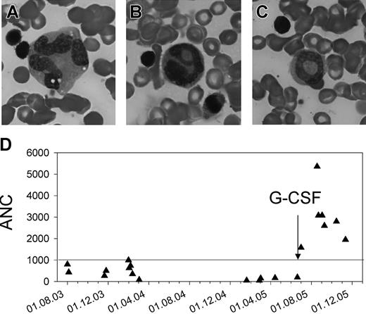 Figure 8. Impaired myeloid maturation and response to G-CSF treatment. (A-C) Bone marrow smear. Multinucleality and vacuolization of a metamyelocyte (A), abnormal nuclear segmentation (B), and a ring nucleus (C) in neutrophils. (D) Absolute neutrophil counts (ANCs) before and after treatment with G-CSF.