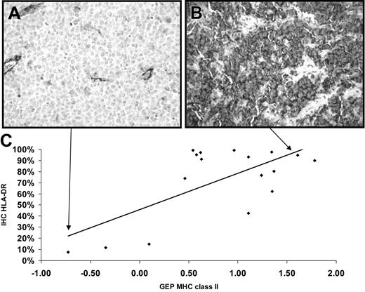 Figure 2. Immunohistochemical detection of HLA-DR and relationship to gene expression. (A) Photomicrograph demonstrating a low HLA-DR-expressing PMBCL case, case 691. Staining of endothelial cells and some histiocytes serves as an internal positive control. (B) Photomicrograph demonstrating a high HLA-DR-expressing PMBCL case, case 824. Original magnification for both × 100. (C) Graph of the relationship between results of immunohistochemistry (IHC) of HLA-DR in percentage of positive tumor cells (y-axis) and average MHC class II gene expression from microarray results (x-axis). Pearson correlation R = 0.68. A trend line is shown to help judge the extent of correlation. Arrows show where the cases pictured above are located in the graph.
