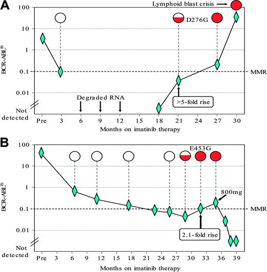 Figure 4. The detection of KD mutations associated with a rise in the BCR-ABL level. The graphs plot the BCR-ABL levels as measured by RQ-PCR76 in 2 late-chronic-phase patients treated in Australia who achieved a CCyR on imatinib 400 mg/daily. The BCR-ABL levels were calculated according to the proposed international scale (IS). The mutation analysis was performed using a direct sequencing technique.77 The mutation results are depicted as open circles when wild-type BCR-ABL was detected; the amount of shading within the circles indicates the relative size of the mutant sub-clone. Diamonds indicate datapoints. (A) After 18 months on imatinib, the patient had undetectable BCR-ABL that was followed by a rise of at least 5-fold. At that time the D276G mutation was detected. The patient remained on 400 mg imatinib and a CCyR was maintained at 27 months. Thereafter the patient progressed rapidly to lymphoid blast crisis. (B) This patient had a rise of 2.1-fold and the E453G mutation was detected prior to the rise. On the basis of the rising BCR-ABL level and the detection of the mutation the dose of imatinib was increased from 400 to 800 mg per day. The BCR-ABL level subsequently decreased and the CCyR was maintained.