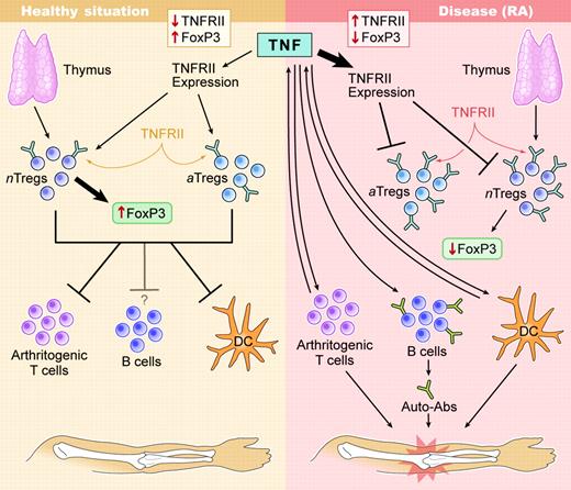 Operational feedback loops involving direct effects of TNF on CD25+ Tregs enhance diseased states in RA. Diseased states in RA are established and stabilized though negative feedback of TNF directly on TGFβ-induced CD25+ Tregs. It is likely that in both populations intrinsic Tregs, as well as adaptively induced Tregs, can be affected. In many individuals, anti-TNF therapy can re-establish the equilibrium present in healthy individuals. Illustration by Kenneth Probst.