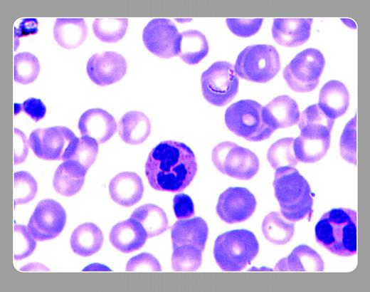 Figure 1. A 45-year-old African American woman had moderately excessive bleeding within an hour after an abdominal hysterectomy. Her platelet count was 54 × 109/L, and the preoperative platelet count that was not evaluated was 85 × 109/L. Her brother had a low platelet count years prior, diagnosed as “idiopathic thrombocytopenic purpura” and treated by splenectomy. Her peripheral smear showed large platelets and Döhle bodies within many of the polymorphonuclear leukocytes. A diagnosis of May-Hegglin anomaly was made. Months later, the mother visited the emergency room with an upper respiratory infection and had a complete blood count showing mild thrombocytopenia. Her peripheral smear also had large platelets and Döhle bodies. . / May-Hegglin is an autosomal dominant disorder that was originally described by May (1909) and later by Hegglin (1945). Other instances of thrombocytopenia with large platelets, many of which also include Döhle bodies were reported later, such as Sebastian syndrome, Fechtner syndrome, and Epstein syndrome. All have a common genetic mutation (MYH9) that encodes for nonmuscle myosin heavy chain IIA that is expressed in platelets, renal cells, granulocytes and the cochlea. . / Clinically, thrombocytopenia in May-Heggelin does not often cause bleeding except with surgery or trauma. Recognition of the familial history and the peripheral blood smear eliminates the need for further laboratory testing or a bone marrow examination. . / Neil Abramson, Baptist Cancer Institute