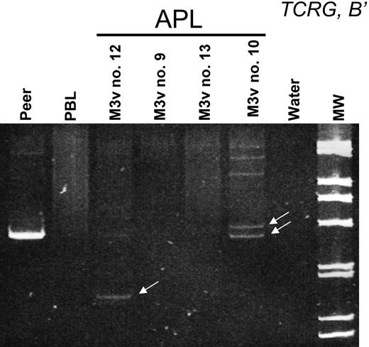 Figure 3. Detection of clonal TCRG rearrangement by heteroduplex analysis of PCR products amplified with TCR Vγ- and Jγ-specific primers, as indicated and electrophoresed on polyacrylamide gels. Peer and peripheral-blood lymphocytes (PBL) represent clonal and polyclonal controls, respectively; MW indicates molecular weight markers. Four samples from M3v APL are demonstrated, 2 of which demonstrate clonal TCRG rearrangements (monoallelic in no. 12 and biallelic in no. 10). Clonal rearrangements are indicated by arrows. Higher molecular weight discrete bands for sample no. 10 correspond to clonal heteroduplexes.