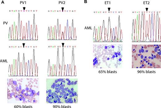Figure 3. V617F- leukemic transformation developed in 3 of 4 patients with a preceding V617F+ MPD. (A) Paired sequence traces on 2 patients with PV from the PV phase (top panel) and leukemic phase (middle panel) of disease showing reversion of mutated nucleotide (arrowheads) to WT. Bottom panels are smears from samples used for sequencing (bone marrow aspirate for PV1 and peripheral-blood mononuclear cells for PV2). (B) Sequence traces from bone marrow samples taken after leukemic transformation in 2 patients with ET (top panel). Samples from before AML transformation showed both patients to be V617F+ by allele-specific PCR (data not shown). Both samples had high percentage of blast cells in their bone marrow aspirates (bottom panels). Romanowsky-stained slides were imaged on an Olympus BX51 microscope (Olympus, Center Valley, PA) equipped with a 40×/0.85 oil-immersion objective lens. A Pixera Penguin 600CL camera (Pixera, Los Gatos, CA) was used to capture images, and Viewfinder 3.0.1 (Pixera) was used to acquire them.
