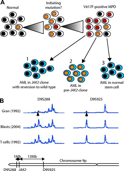 Figure 4. Models for the development of V617F- AML from a V617F+ MPD. (A) Three possible models are shown, in which V617F- AML could develop from (1) a V617F+ cell that subsequently reverts to V617F-; (2) a cell that had some other initiating mutation prior to JAK2; or (3) a normal stem cell. (B) Microsatellite analysis on peripheral-blood granulocytes and T cells from the PV phase of disease (taken in 1992) and blasts from leukemic transformation (2004) for 2 markers on chromosome 9p either side of JAK2 from patient PV2.