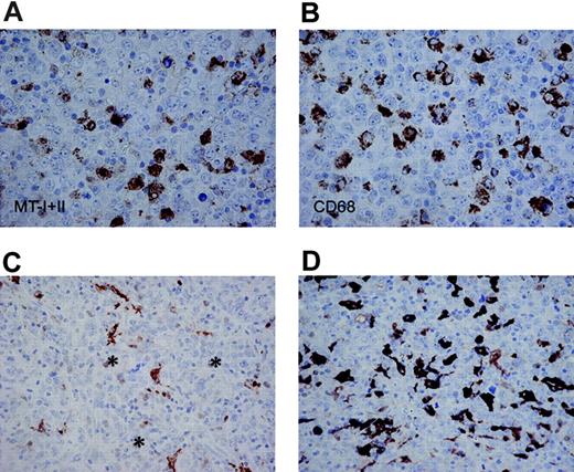 Figure 3. MT-I and MT-II staining of tumor-infiltrating macrophages. Adjacent sections of a DLBCL stained for MT-I and MT-II (A, DAKO-MT × 600) and CD68 (B, PGM1 × 600) showing numerous MT-positive stromal cells with a dendritic morphology (A), similar to the pattern with CD68 (B). In panels C and D, DLBCL with few (C) and abundant (D) numbers of MT-positive tumor-infiltrating macrophages is shown (DAKO-MT × 400). In these cases, only very occasional tumor cells (asterisks in C) are stained with a weak nuclear reactivity.