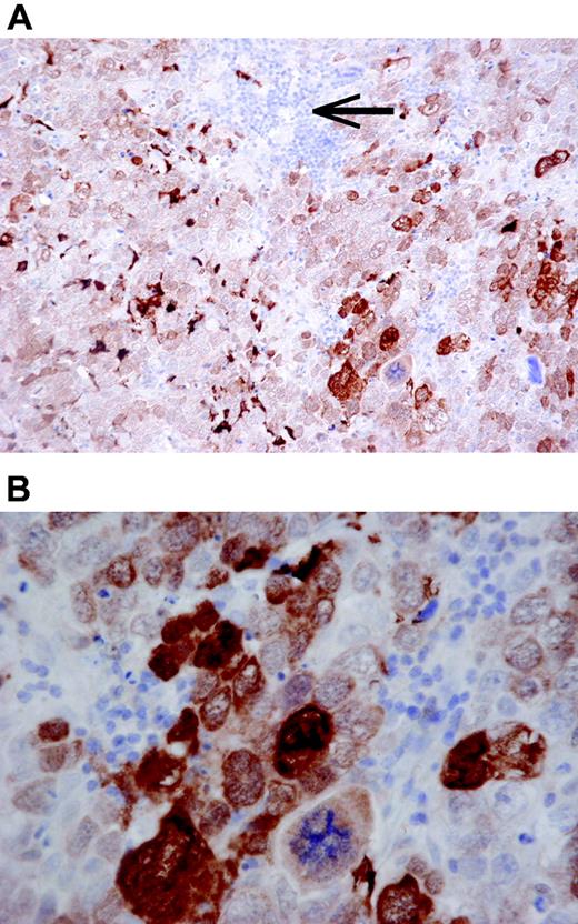 Figure 5. A DLBCL with strong MT staining of a majority of the tumor cells in both nuclei and cytoplasm (A, DAKO-MT × 200; B, DAKO-MT × 600). Note that small reactive lymphocytes (arrow) are MT negative.