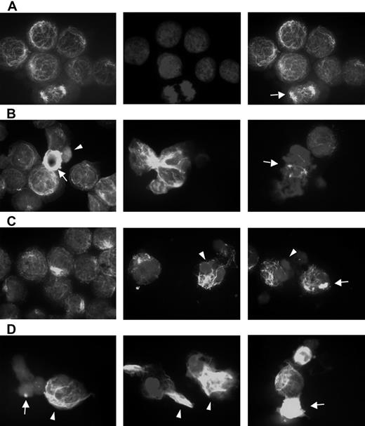 Figure 5. Bortezomib-induced aggresome formation and LBH589-induced α-tubulin hyperacetylation. RPMI8226 cells were treated for 24 hours with 16 nM LBH589, 16 nM bortezomib, or both, stained with anti-acetyl-α-tubulin and DAPI, then examined by inverted microscopy. (A) In untreated RPMI8226 cells, acetylated α-tubulin showed a reticulated appearance (left panel). The center panel shows the DAPI stain. In the merged image in the right panel, a normal mitotic figure (arrow, right panel) is shown, as well as other nondividing cells. (B) HDAC inhibitor LBH589 induced diffuse or segmented α-tubulin hyperacetylation. Hyperacetylated-α-tubulin (arrow, left panel); diffuse acetyl-α-tubulin (arrowhead, left panel); segmented α-tubulin hyperacetylation (center panel); mitotic figure (arrow, right panel). (C) Proteasome inhibitor bortezomib induced aggresomes in the presence of normal reticulated α-tubulin (left panel). Focal aggresome (arrow, right panel); apoptotic nuclei (arrowheads, center and right panels). (D) LBH589 and bortezomib induced large bundles of hyperacetylated α-tubulin (arrowheads, left and center panels) that were not seen in cells treated with LBH589 alone. Diffuse hyperacetylated α-tubulin was also observed (arrow, right panel). Although aggresome formation was observed (arrow, left panel), here they were smaller than when treated with bortezomib alone, and were associated with a diffuse cytoplasmic background and apoptotic nuclei.