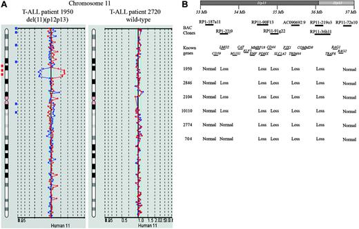 Figure 1. New recurrent deletion, del(11)(p12p13), in pediatric T-ALL. (A) Chromosome 11 ideogram and corresponding BAC array-CGH plot of test DNA/control DNA ratios (blue tracing) versus the dye-swap experiment (red tracing) for T-ALL patients 1950 (left panel) and 2720 (right panel). (B) Overview of BAC array-CGH results for the 11p12-11p13 region for the 4 DCOG and the 2 COALL T-ALL patients with del(11)(p12p13). The BAC clones present on the DNA array and located on chromosome bands 11p12-11p13 are shown. Specific genes located in this region are indicated. Depicted genome positions are based on the UCSC Genome Browser at http://genome.ucsc.edu/.